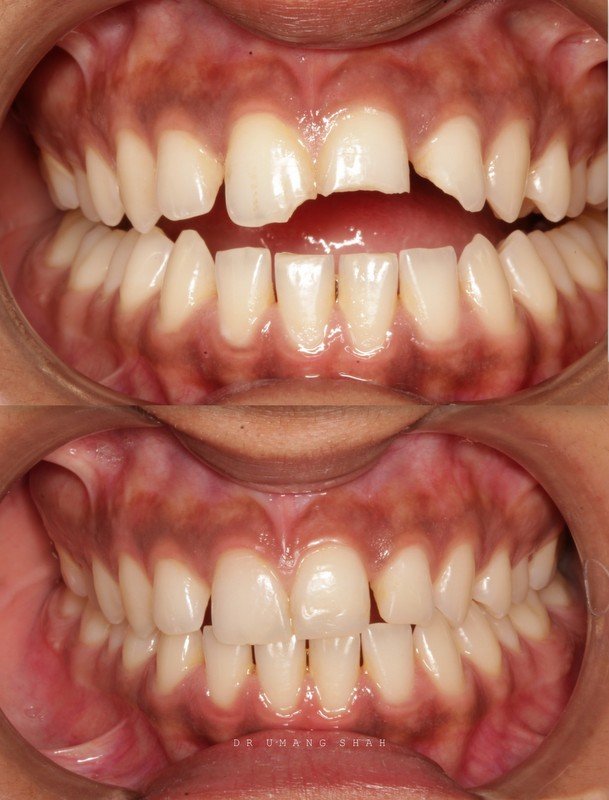 Composite bonding before and after — fractured front tooth rebuilt with tooth-coloured resin, The Dental Ethics Pune