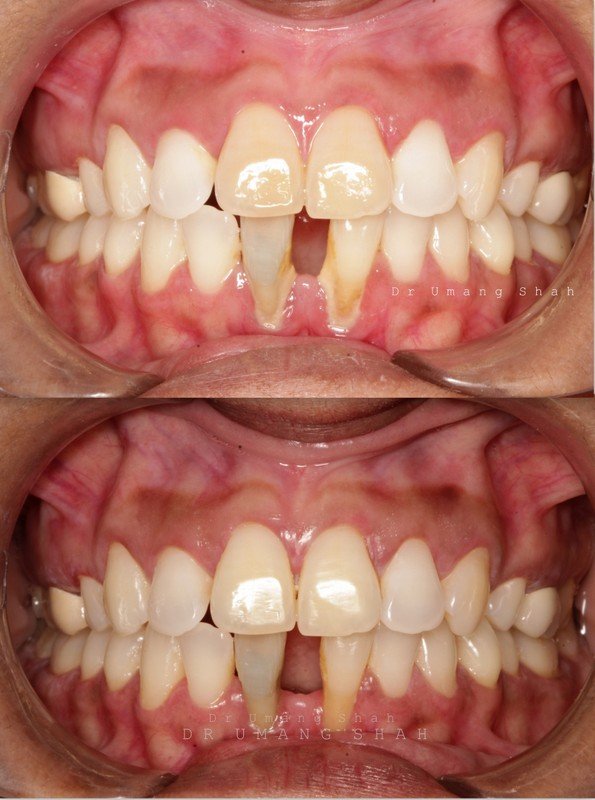 Aesthetic bonding before and after — badly broken upper front teeth restored, Pune cosmetic dentistry