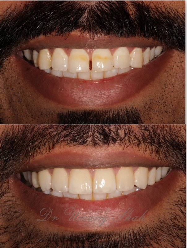 Edge bonding before and after — chipped and gapped front teeth restored and brightened, Pune