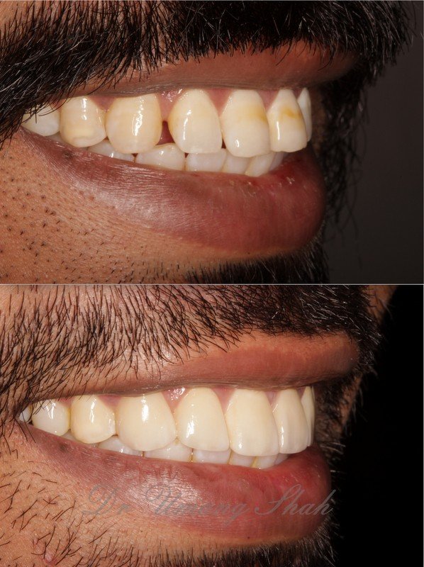 Composite bonding before and after — chipped tooth edge rebuilt for a seamless smile, The Dental Ethics Pune