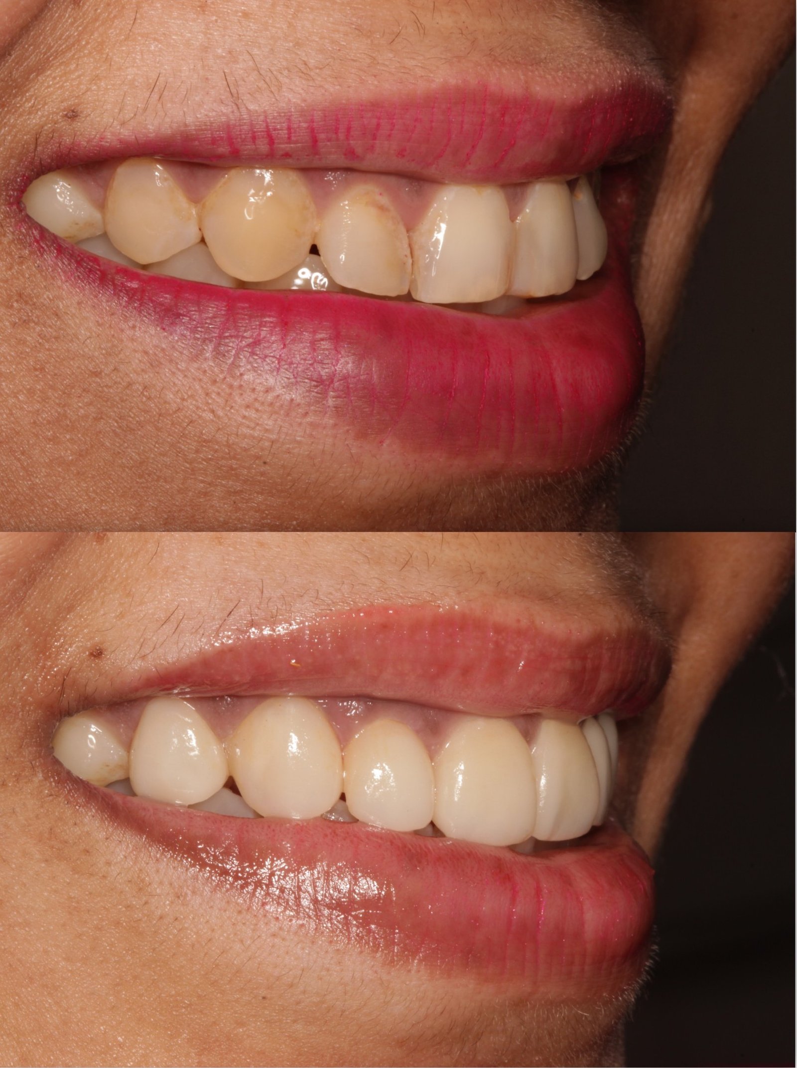 Aesthetic composite bonding before and after — discoloured, uneven front teeth resurfaced, Pune cosmetic dentist