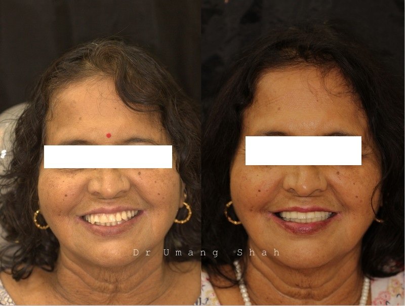 Full mouth reconstruction before and after — worn, broken-down teeth fully rebuilt, The Dental Ethics Pune
