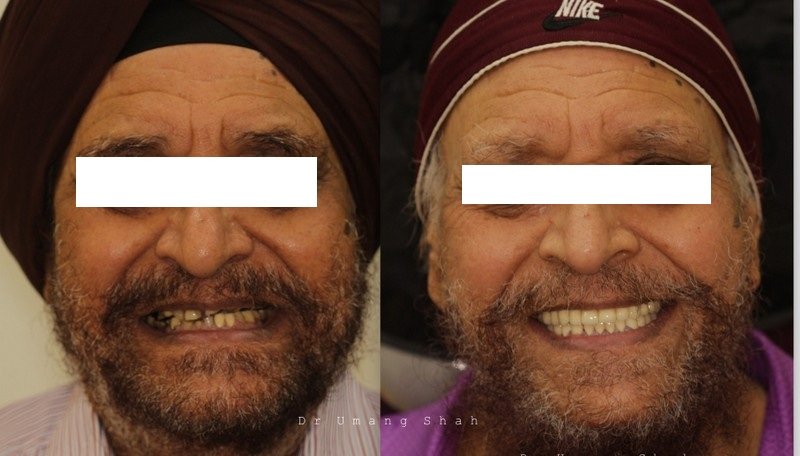 Full mouth rehabilitation before and after — missing and decayed teeth restored with implants and crowns, Pune