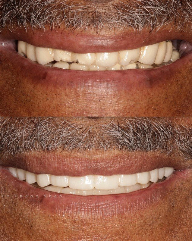 Full arch reconstruction before and after — complete upper and lower teeth rebuilt, The Dental Ethics