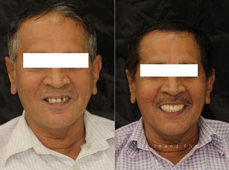 Full mouth rehabilitation before and after — multiple missing teeth replaced for a complete smile, Pune