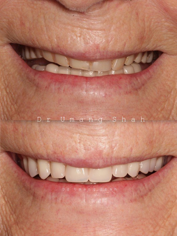 Full mouth reconstruction before and after — full set of natural-looking replacement teeth, The Dental Ethics Pune