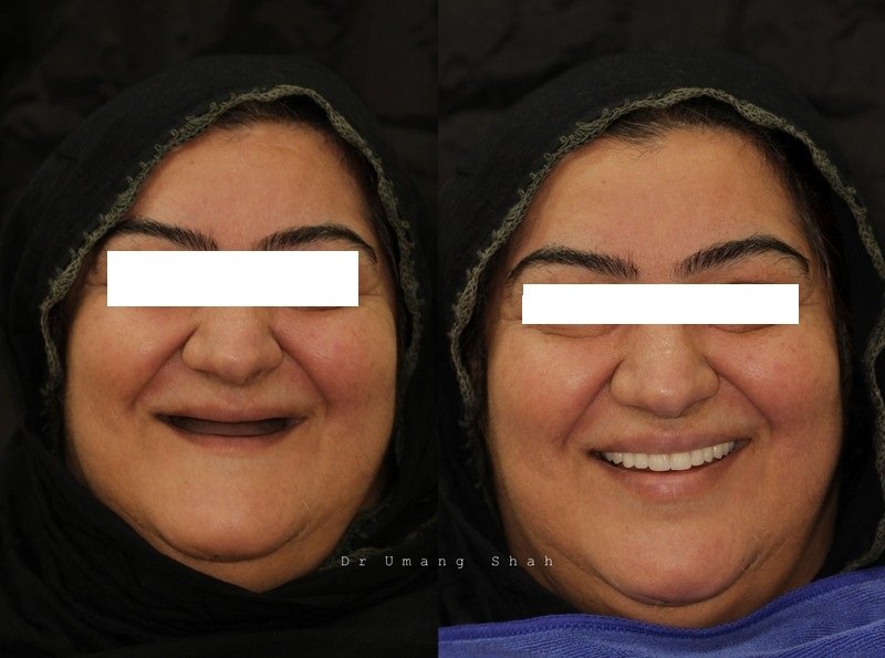 Full mouth rehabilitation before and after — toothless smile restored with a fixed full-arch restoration, Pune