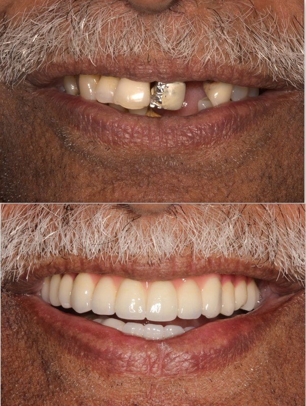 Full mouth reconstruction before and after — failing teeth and old crowns replaced with implants, The Dental Ethics