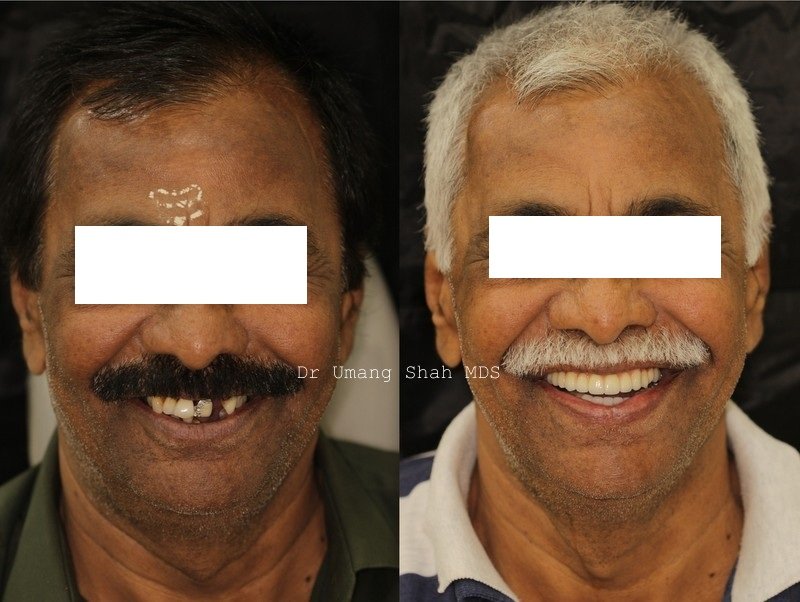 Full mouth rehabilitation before and after — complete smile makeover for an elderly patient, Pune dental implants