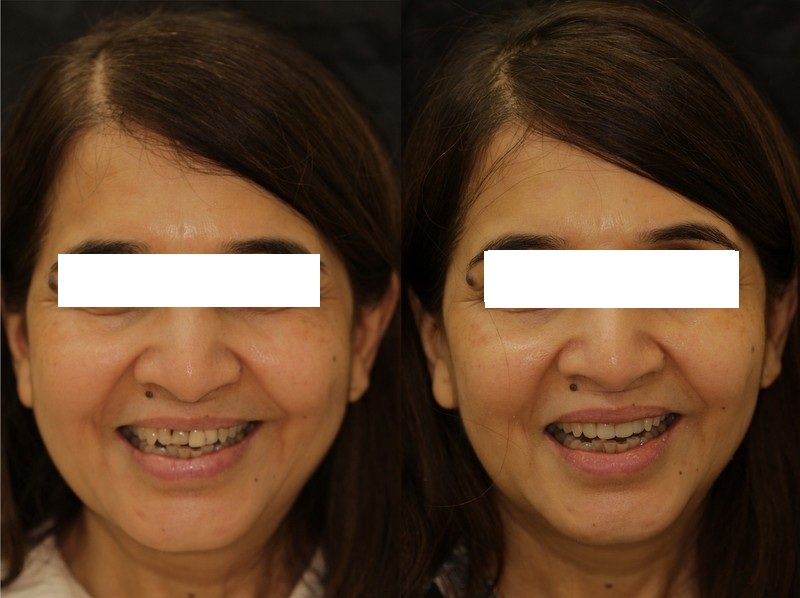Smile designing before and after — crowded, discoloured upper teeth restored to an even, bright smile, The Dental Ethics Pune