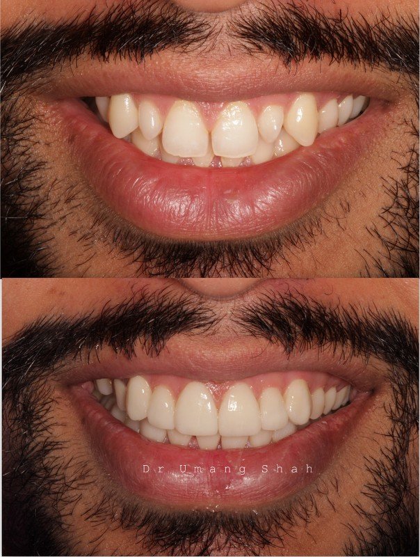 Smile makeover before and after — protruding, misaligned front teeth corrected, Pune cosmetic dentistry