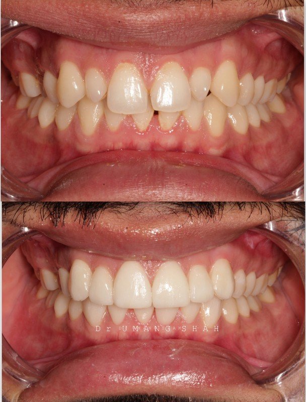 Smile design before and after — spacing and gaps between teeth closed for a uniform smile, The Dental Ethics