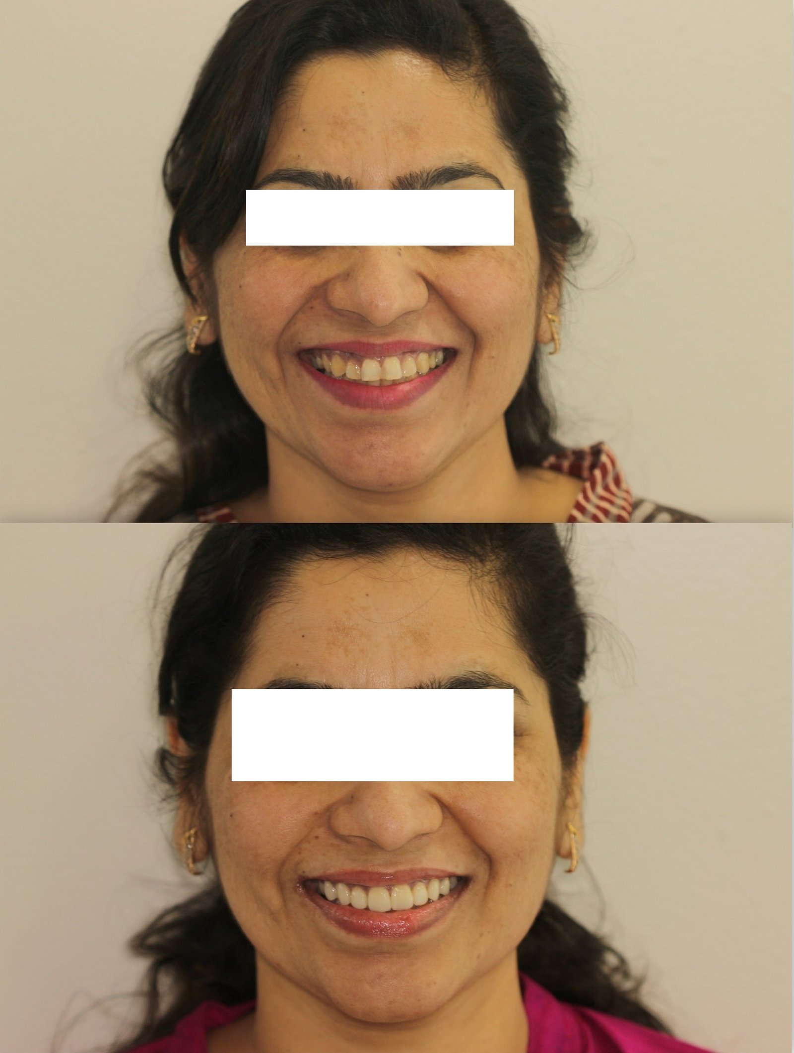 Full smile makeover before and after — crooked teeth transformed into a straight, confident smile, Pune