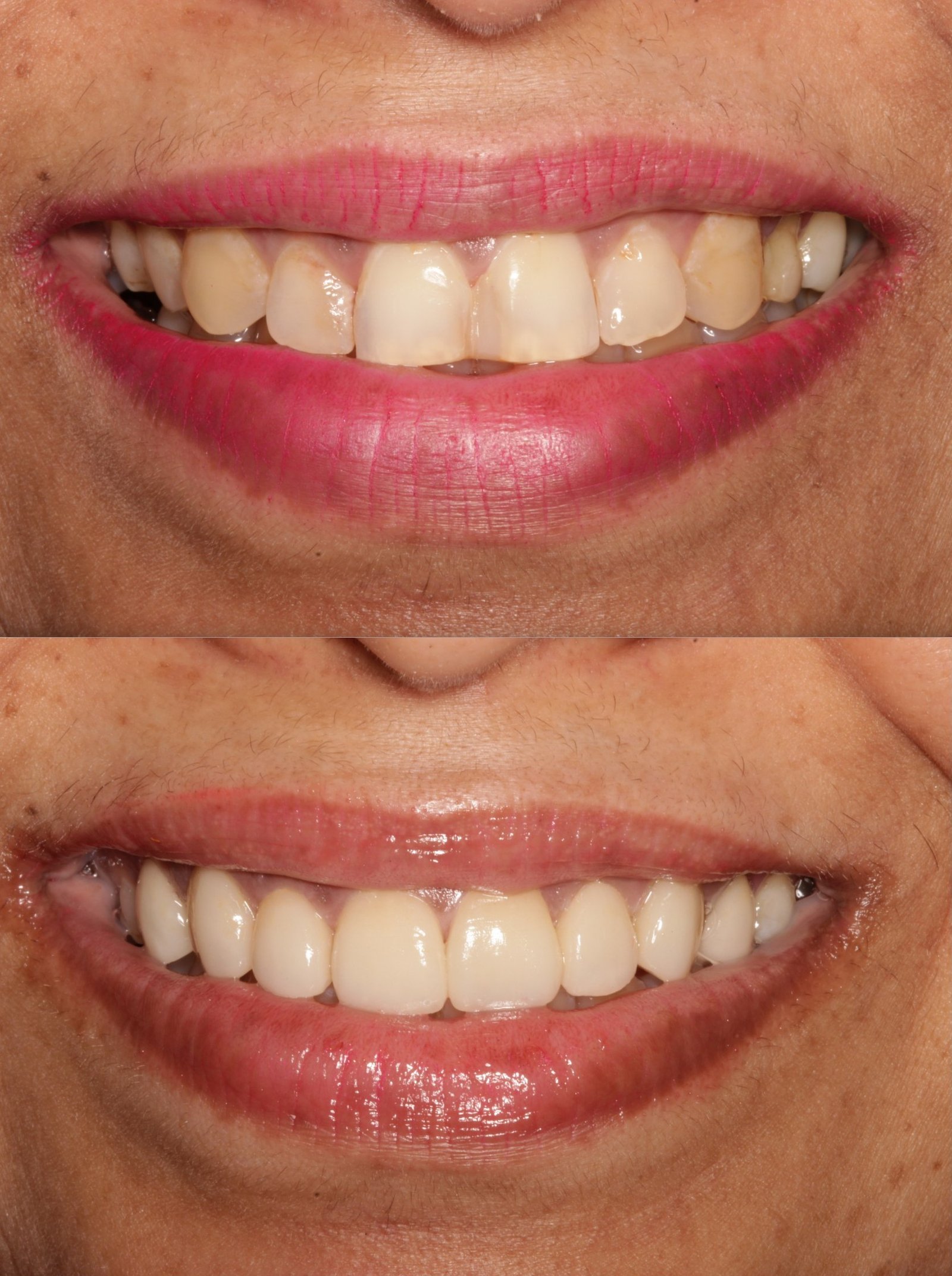 Cosmetic smile designing before and after — worn, uneven teeth rebuilt to an even smile line, The Dental Ethics