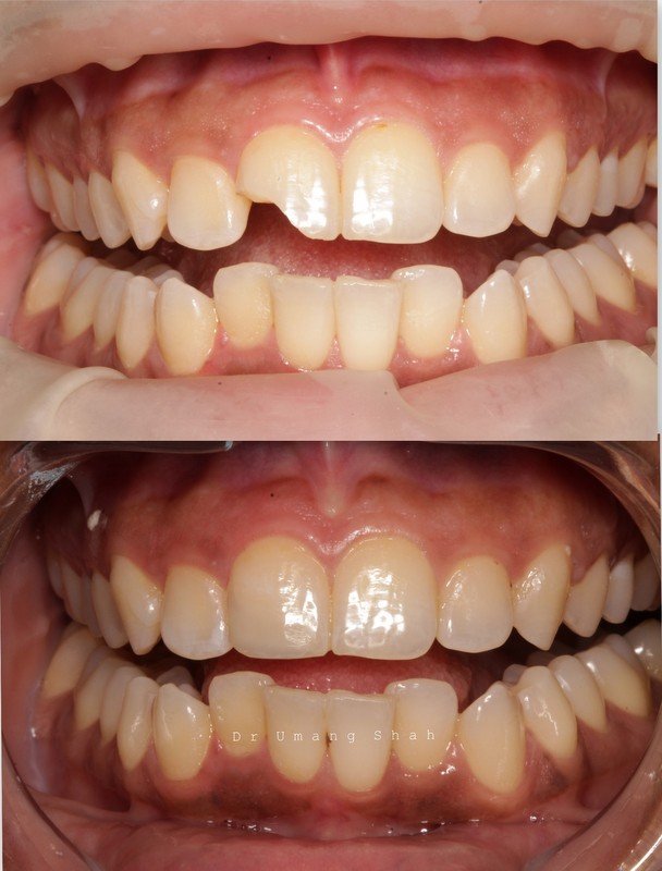 Smile transformation before and after — dull, irregular teeth restored to a fresh, natural smile, Pune