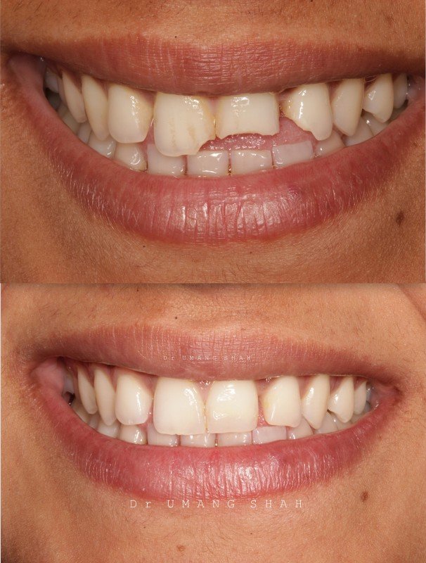 Smile designing before and after — missing front tooth and gap restored for a complete smile, The Dental Ethics