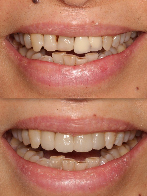 Smile makeover before and after — worn lower teeth reshaped and brightened, Pune cosmetic dentist