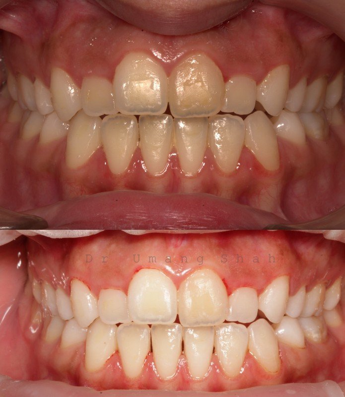 Teeth whitening before and after — yellow, stained teeth brightened several shades, The Dental Ethics Pune