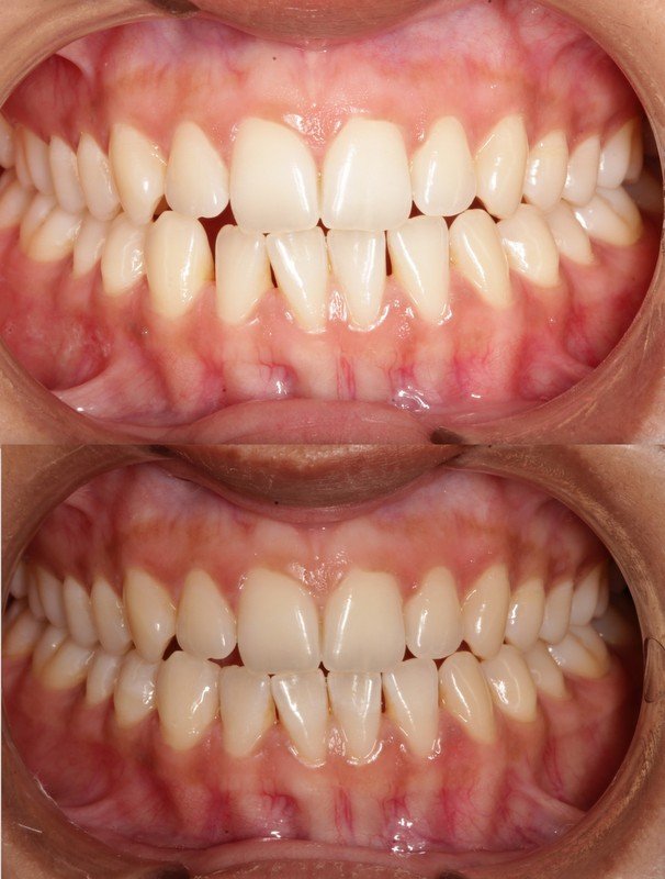 Professional bleaching before and after — dull teeth restored to a bright white shade, Pune cosmetic dentistry