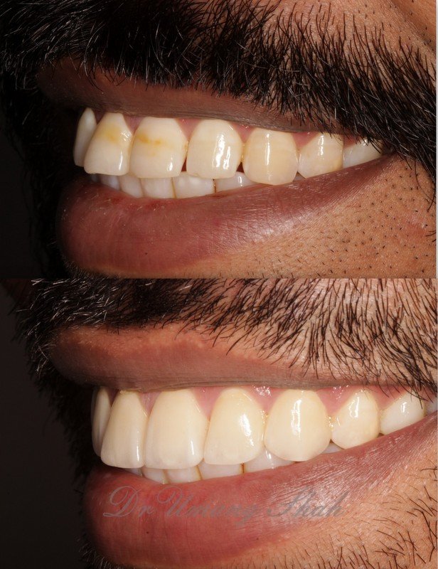 Teeth whitening before and after — discoloured front teeth whitened for a fresh smile, The Dental Ethics