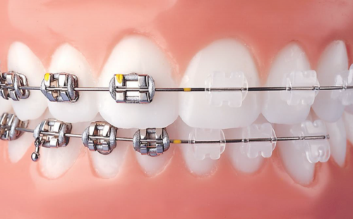 Teeth alignment orthodontics in pune