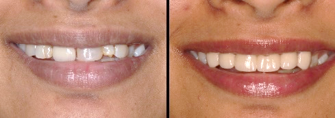 smile makeover treatment in pune