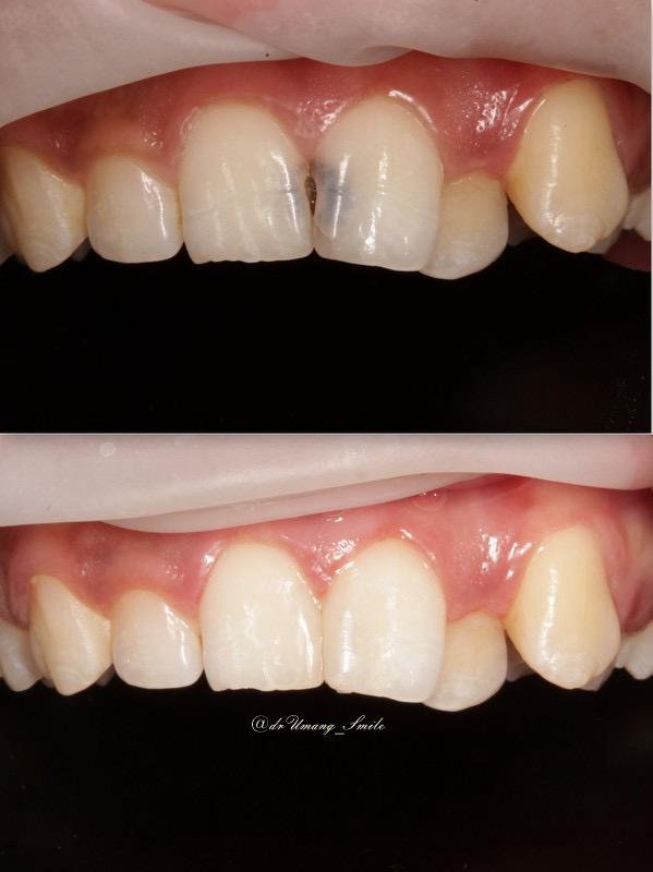 best clinic for invisible Aligner