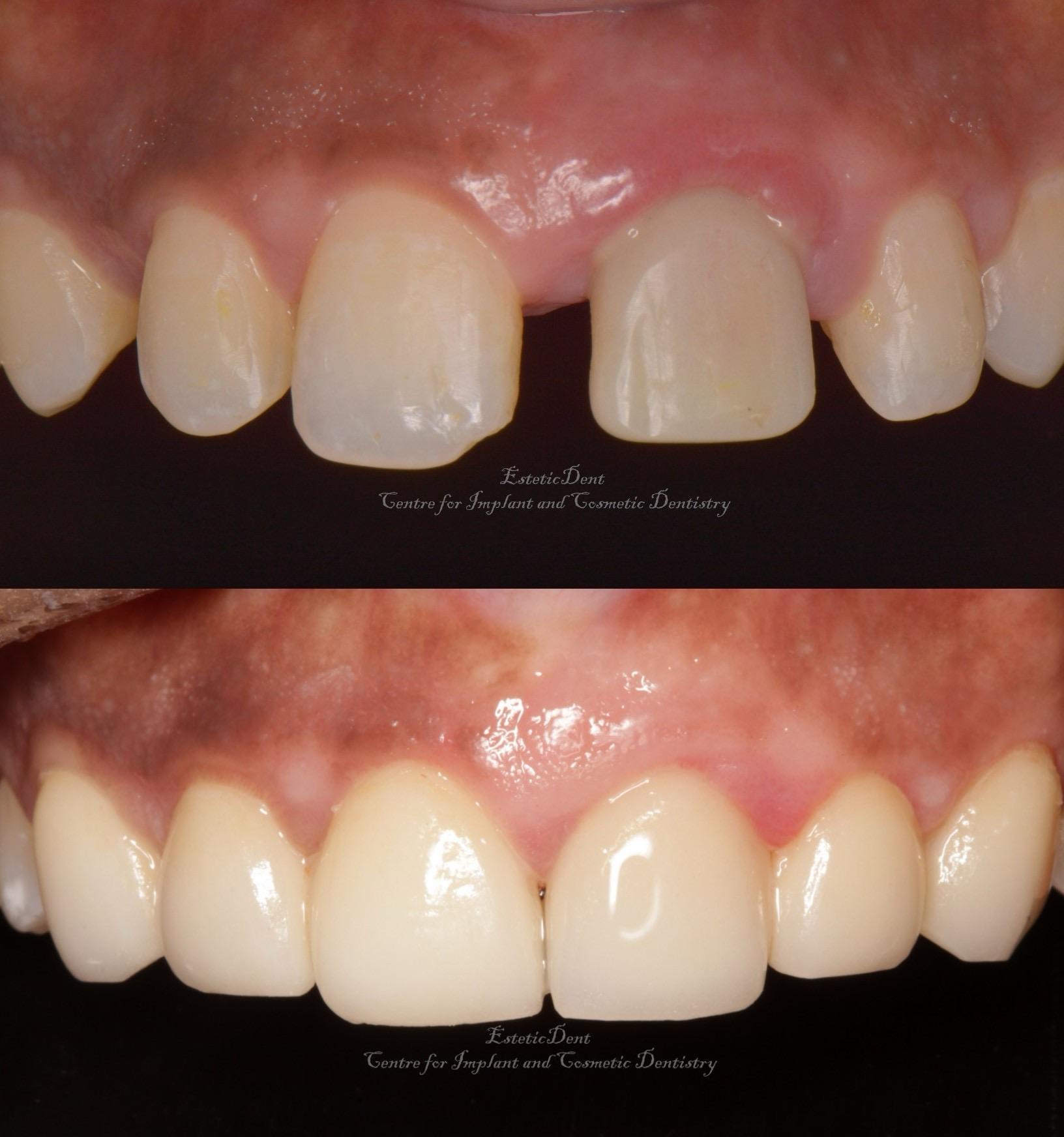 Full Mouth Rehabilitation