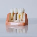 Dental implant model showing a titanium implant replacing a missing tooth — The Dental Ethics, Pune