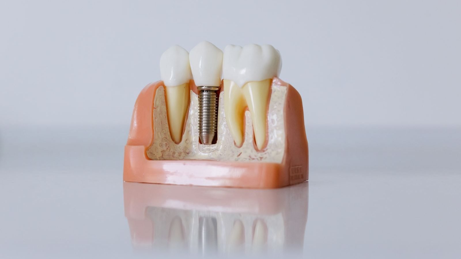 Dental implant model showing a titanium implant replacing a missing tooth — The Dental Ethics, Pune