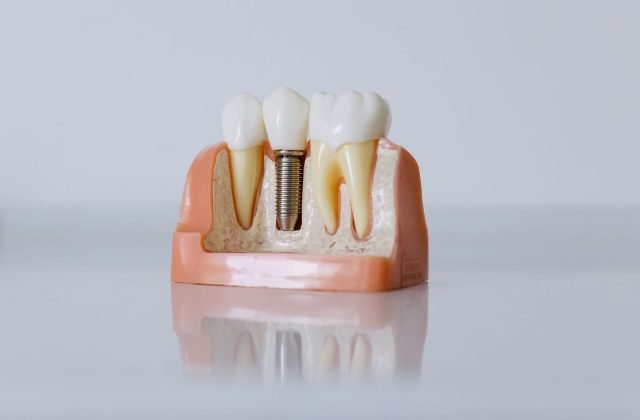 Dental implant model showing a titanium implant replacing a missing tooth — The Dental Ethics, Pune